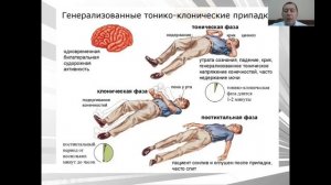 Лекция. Эпилепсия у детей.