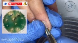 Зеленые ногти/ синегнойка под ногтями/ синегнойная палочка
