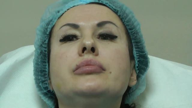 Какой филлер выбрать и как он себя поведёт в разных зонах при FULL FACE коррекции. Dr.Valeriy Potiy