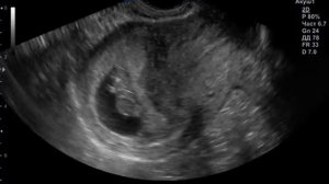 Беременность 8 недель. Диамниотическая, дихориальная двойня