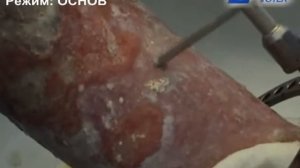 Ультразвуковая обработка гнойной раны