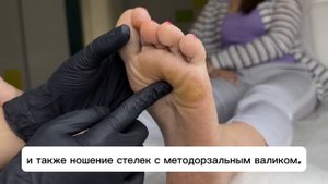 Натоптыши ? Причины образования