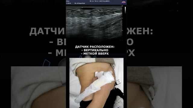 Как выглядит РОДИНКА на УЗИ? смотреть онлайн