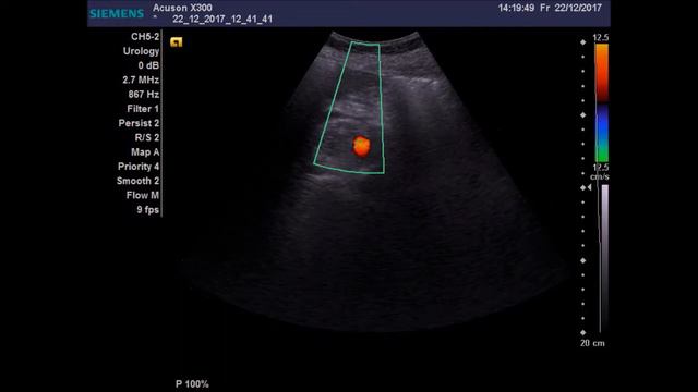 Исход уретеролитиаза, нефролитиаз смотреть онлайн