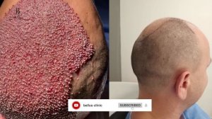 hair transplant in Bellus clinic