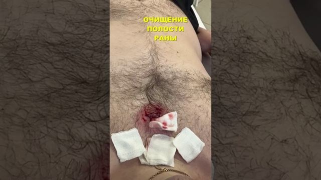 Вскрытие атеромы смотреть онлайн