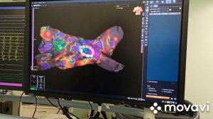 РЧА фибрилляции предсердий (мерцательной аритмии) после торакоскопической аблации