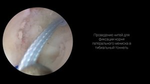 Шов ПКС, обоих менисков, фиксация корня латерального мениска