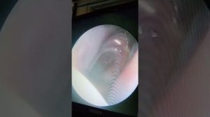 DNS to right with concha bullosa