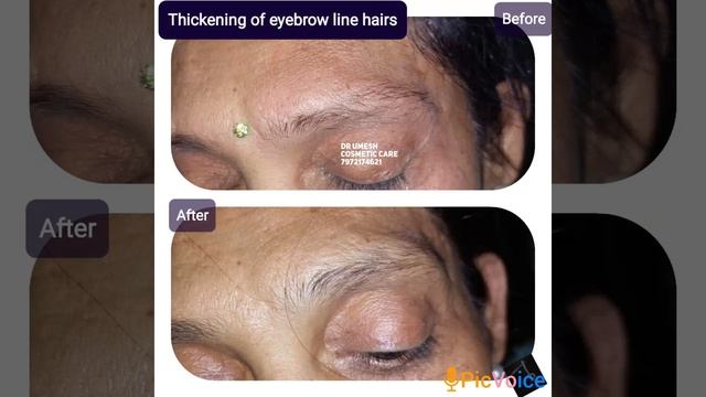 thickening of eyebrow hair смотреть онлайн