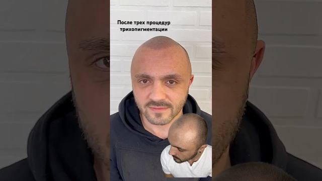 Возвращаем молодость, востанавливаем фронтальную линию роста волос #scalpmicropigmentation