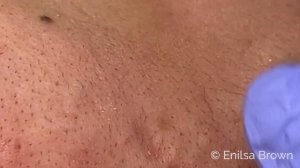 Blackhead & Whitehead Extractions on K