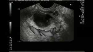 дермоидная киста?