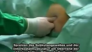 Дренирование плевральной полости по Бюлау
