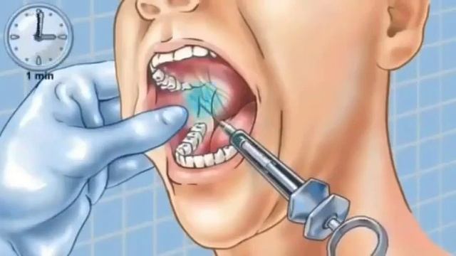 местная анестезия в стоматологии