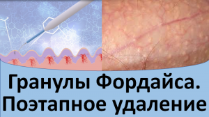 Гранулы Фордайса поэтапное удаление