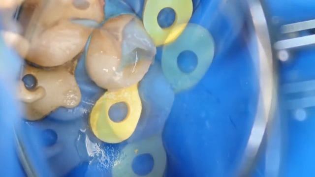 Постановка пломбы после лечения кариеса , удаление нерва зуба , пломбировка каналов зуба , кариес