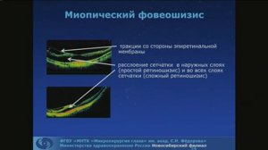 Дулидова В.В. Миопическая макула. ОКТ-диагностика.