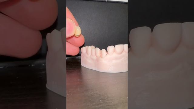 Vertiprep Crown #dentistry #restorativedentistry #prosthodontic #dentalcrowns #digitaldentistry