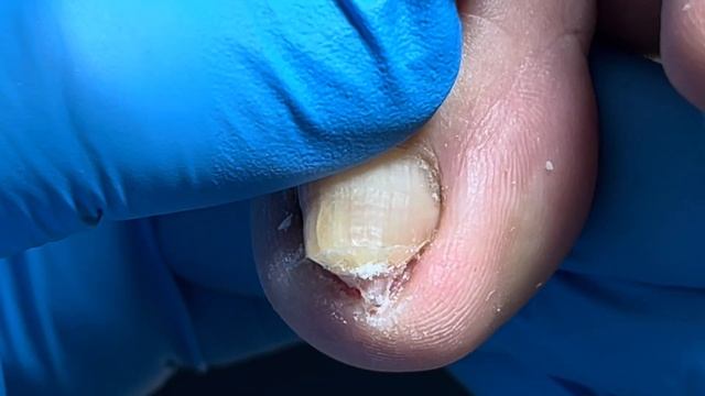 The patient wears tight shoes and the nails curl into the flesh【Pedicure Master Lin Jun】 смотреть онлайн