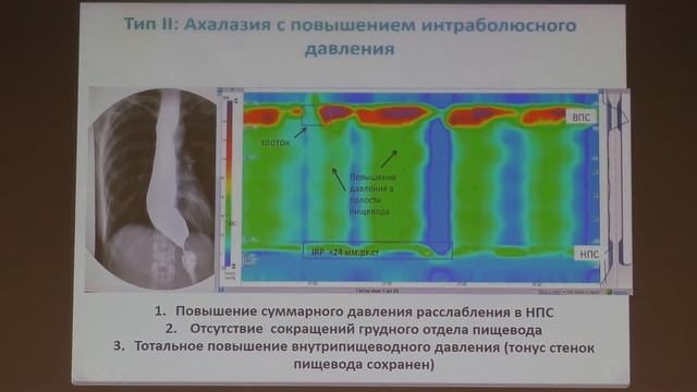 22 Кайбышева ВО Манометрия пищевода высокого разрешения в выборе тактике лечения смотреть онлайн