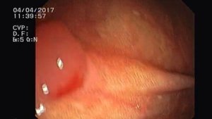 Колоноскопия. Меланоз толстой кишки. Полип толстой кишки