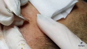 Acnes Treatment Service: Popping Blackhead Acnes Ver 2