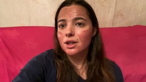 Химический пилинг ТСА 25% Подробный отчёт весь: процесс + до и после. Моя борьба с рубцами постакне