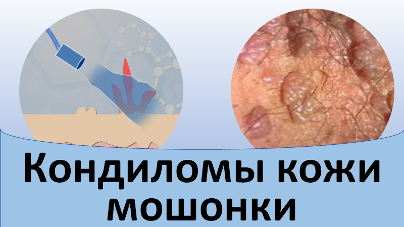 Кондиломы кожи мошонки.