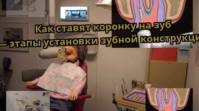 Как ставят коронку на зуб — этапы установки зубной конструкции смотреть онлайн