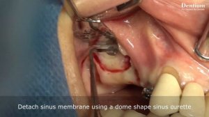 Short & Narrow implantation with sinus elevation