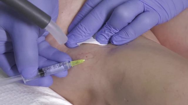 Лечение варикоза и сосудистых звездочек. Склеротерапия смотреть онлайн