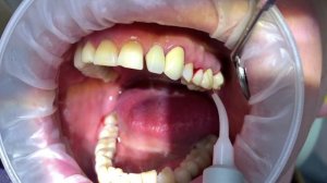 Лечение пародонтита и пародонтоза лазером