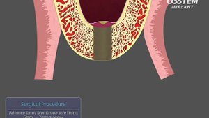 Имплантаты Osstem Implant (Южная Корея)