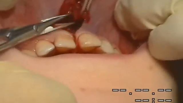 Френулопластика по Гликман испр смотреть онлайн