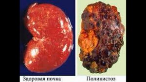 Моя #пациентка откуда #боль и непропущенный #рак #почки#лечебно-диагностическая#блокада#поясница