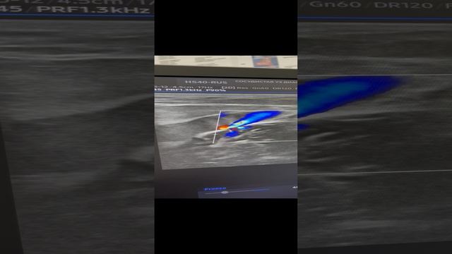 Варикоз на узи. Обследование сосудов. Лечение варикоза. Флеболог Москва. Флеболог смотреть онлайн