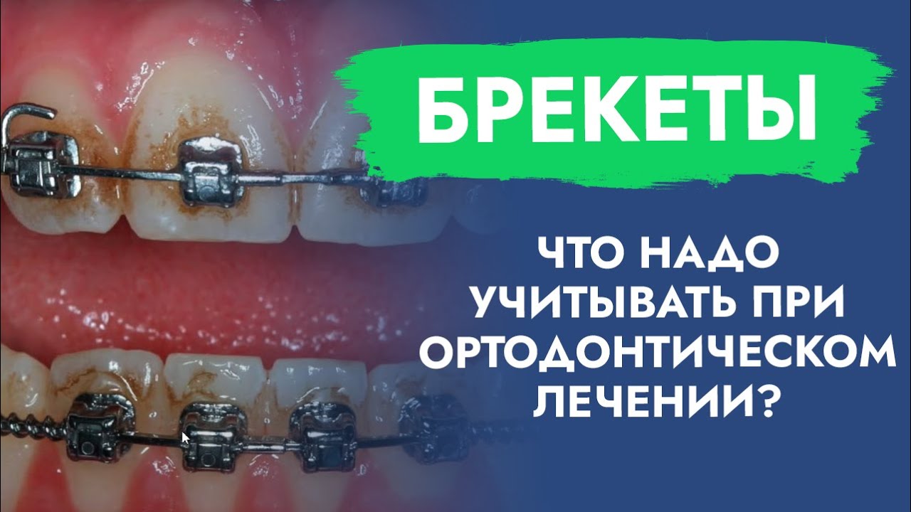 Брекеты. Что надо учитывать при ортодонтическом лечении?