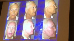 Глубокий химический пилинг/не хирургический метод омоложения/профессор Пухов А.Г/пластический хирур