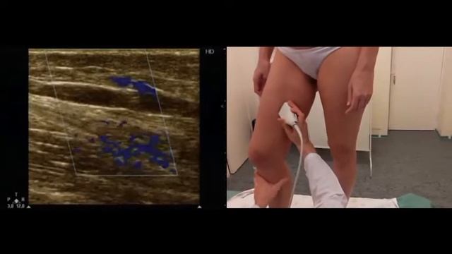 Технология исследования вен нижних конечностей