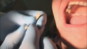 Пациентка "С". Несъемные бюджетные протезы. Дневник врача  интерна. 4- я стоматология.