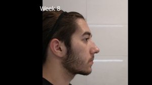 Minoxidil Beard Growth - 3 Month Transformation - Timelapse (BEFORE and AFTER)