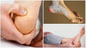 Пяточная ШПОРА -симптомы, лечение, профилактика, рецепты