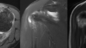 Подробный анализ МРТ плечевого сустава