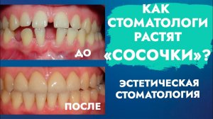 Десневые, межзубные сосочки. Эстетика в стоматологии.