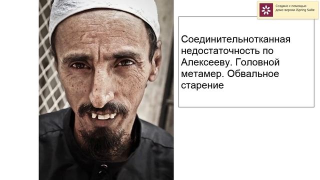 Соединительнотканная недостаточность по Алексееву.