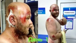 Жёсткое падение с велосипеда и последствия!