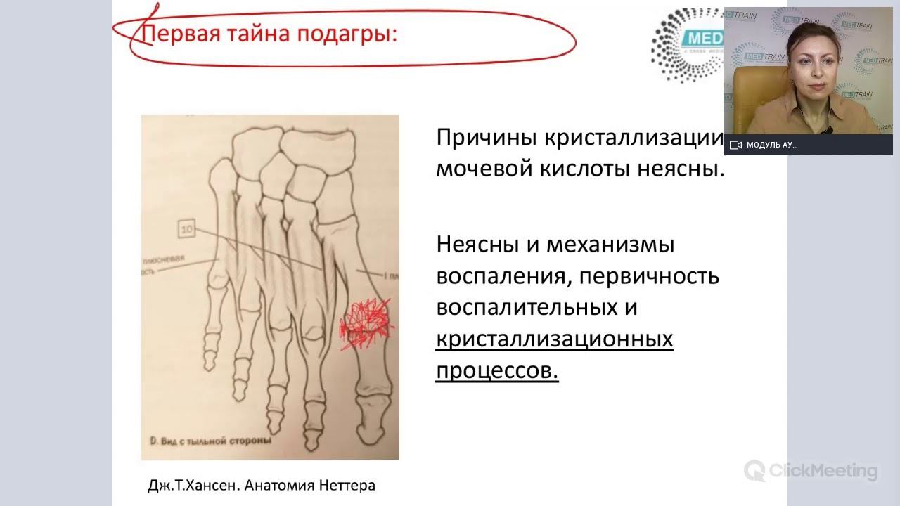 Бесплатный вебинар  «Подагра – многоликая и безобразная»