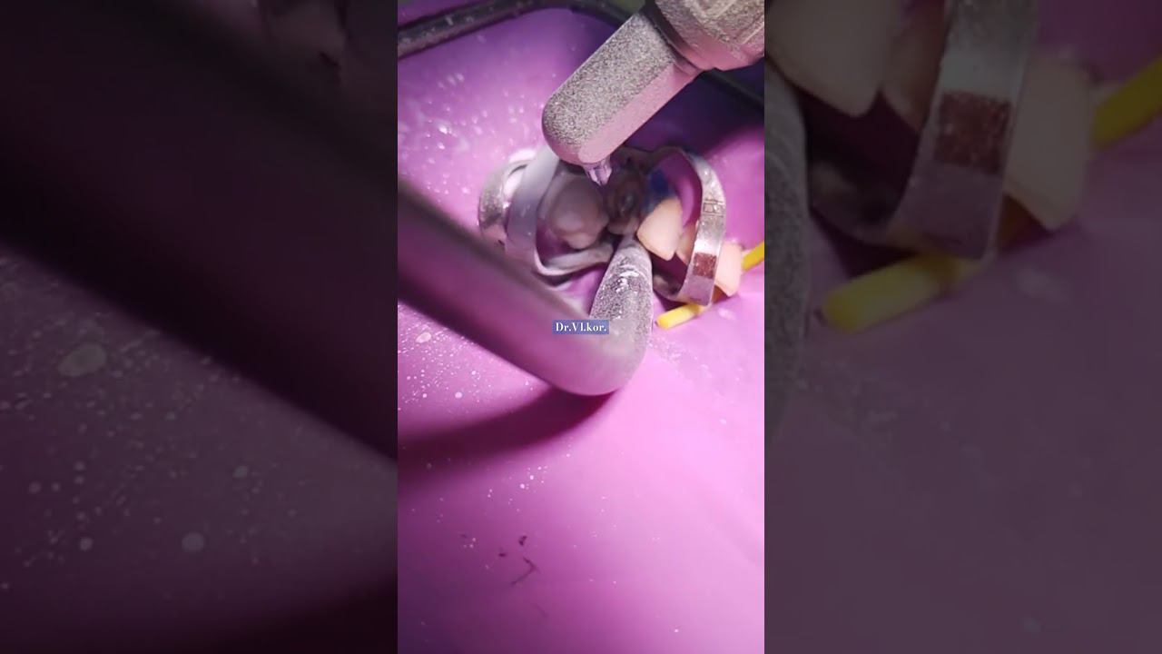 Piaskowanie powierzchni zęba 33 tlenkiem glinu 30 mikronów.#abrasiveblasting