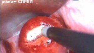 Аргоноплазменная коагуляция при гиперкератозе шейки матки